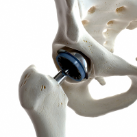 implants_and_prostheses